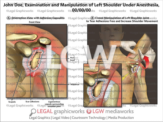 Examination and Manipulation of Left Shoulder under Anesthesia