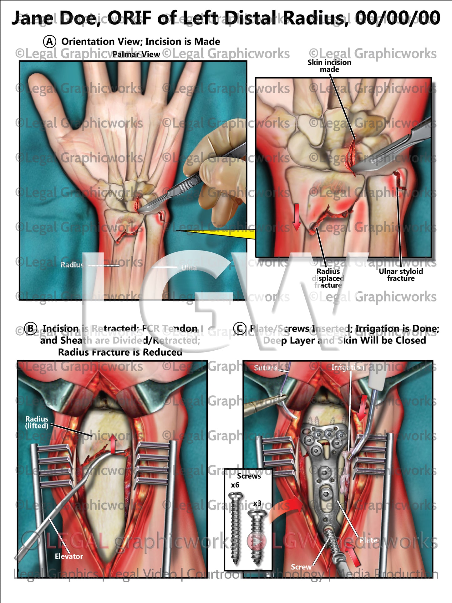 ORIF of Left Distal Radius