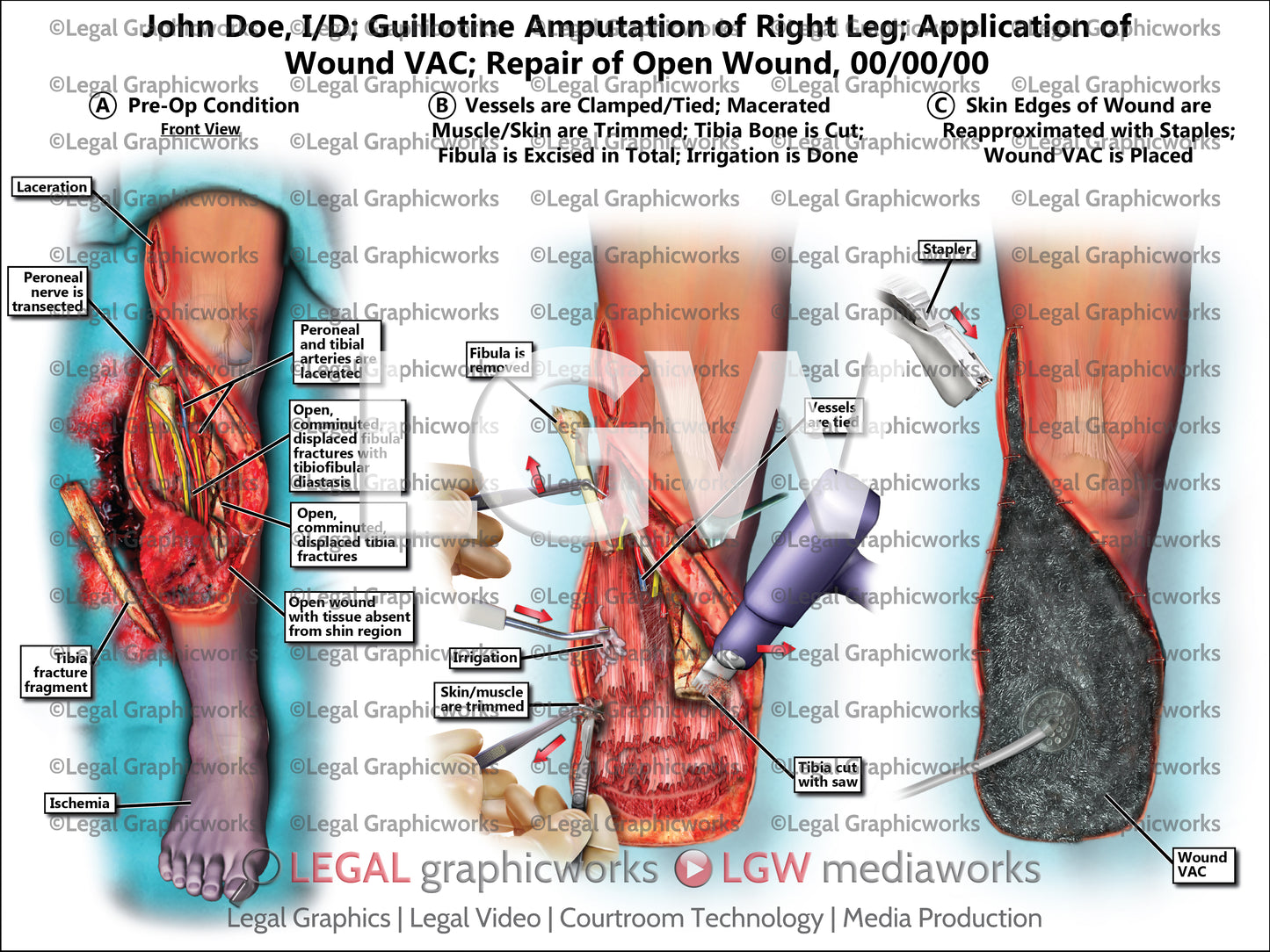 I/D; Guillotine Amputation of Right Leg; Application of Wound VAC; Repair of Open Wound