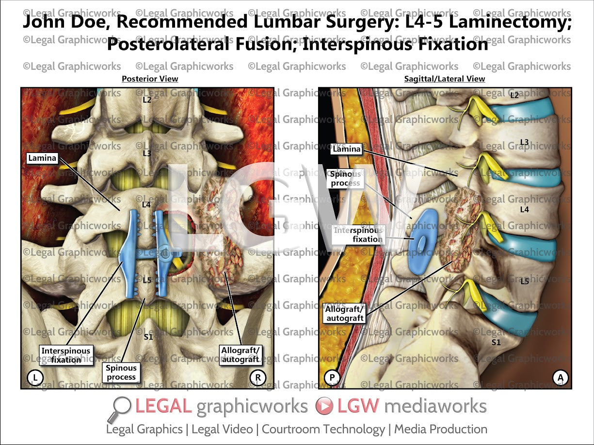Recommended Lumbar Surgery: L4-5 Laminectomy; Posterolateral Fusion; Interspinous Fixation