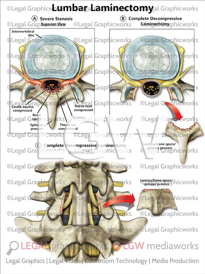 Lumbar Laminectomy