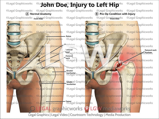 Injury to Left Hip