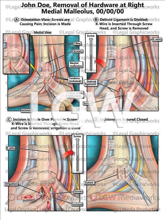 Removal of Hardware at Right Medial Malleolus