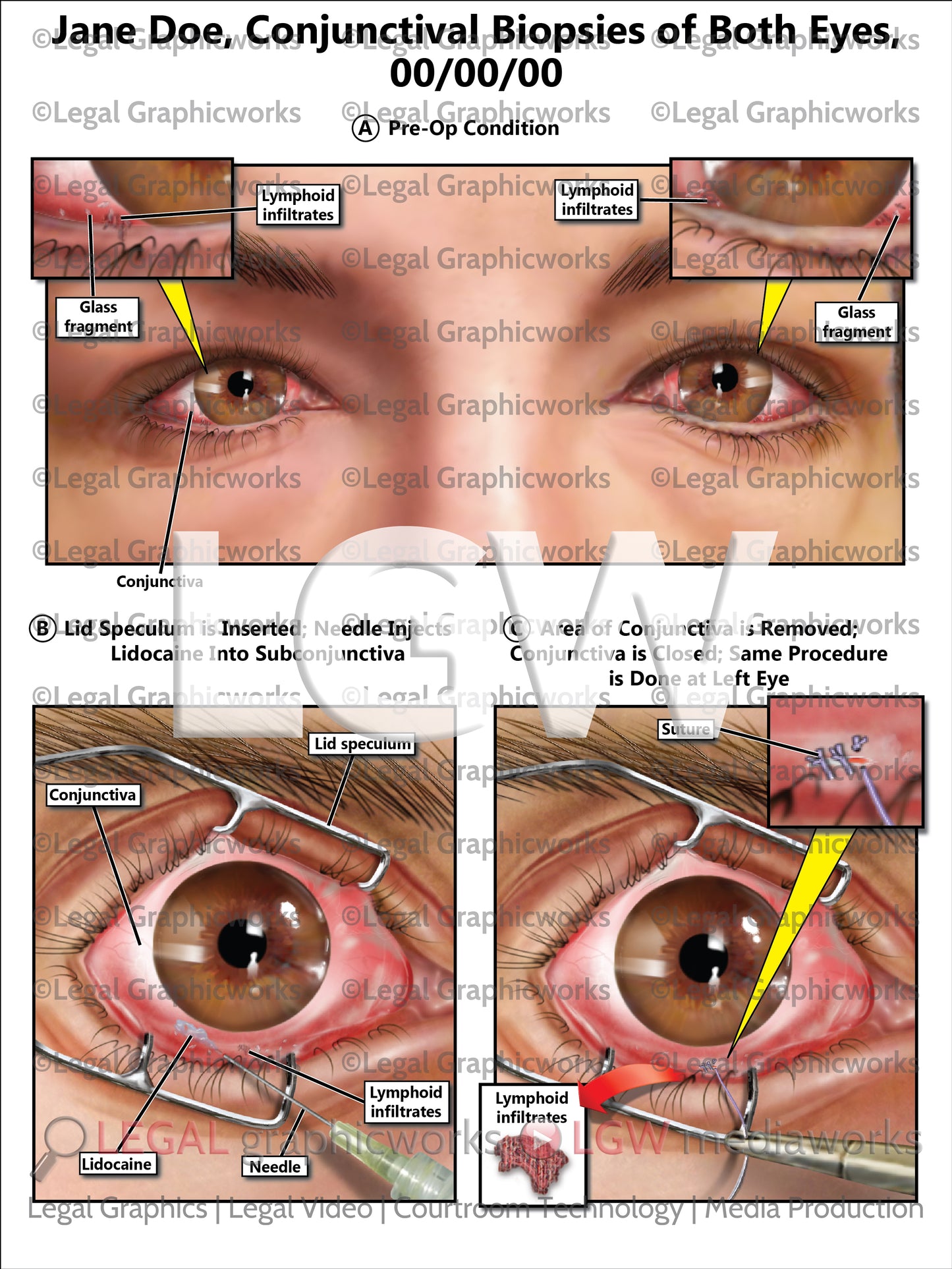Conjunctival Biopsies of Both Eyes