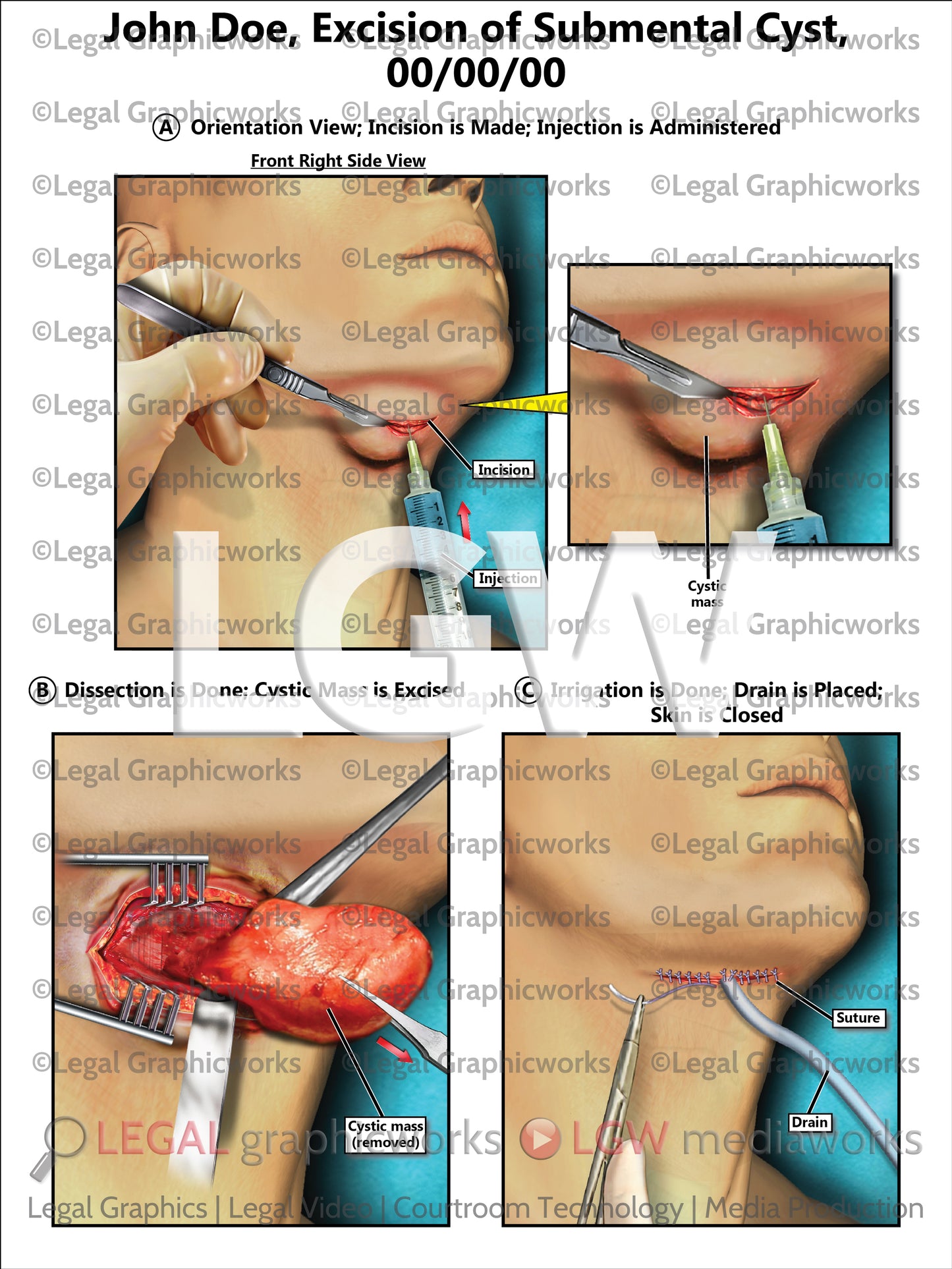 Excision of Submental Cyst