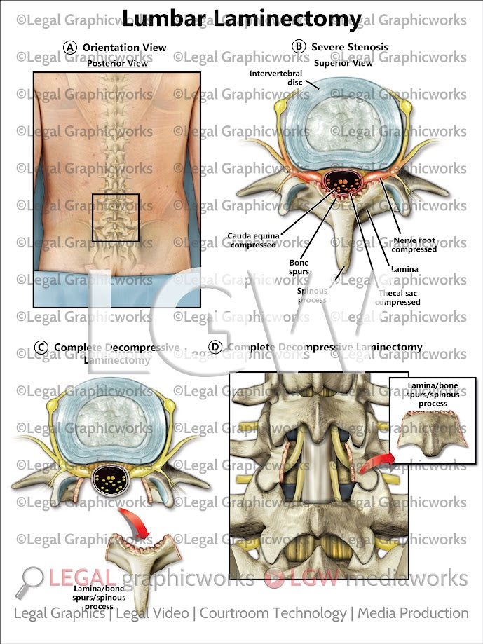 Lumbar Laminectomy