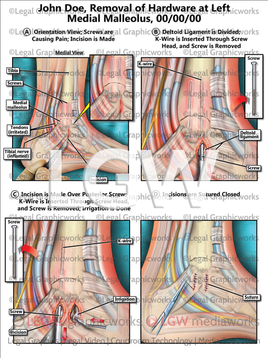 Removal of Hardware at Left Medial Malleolus