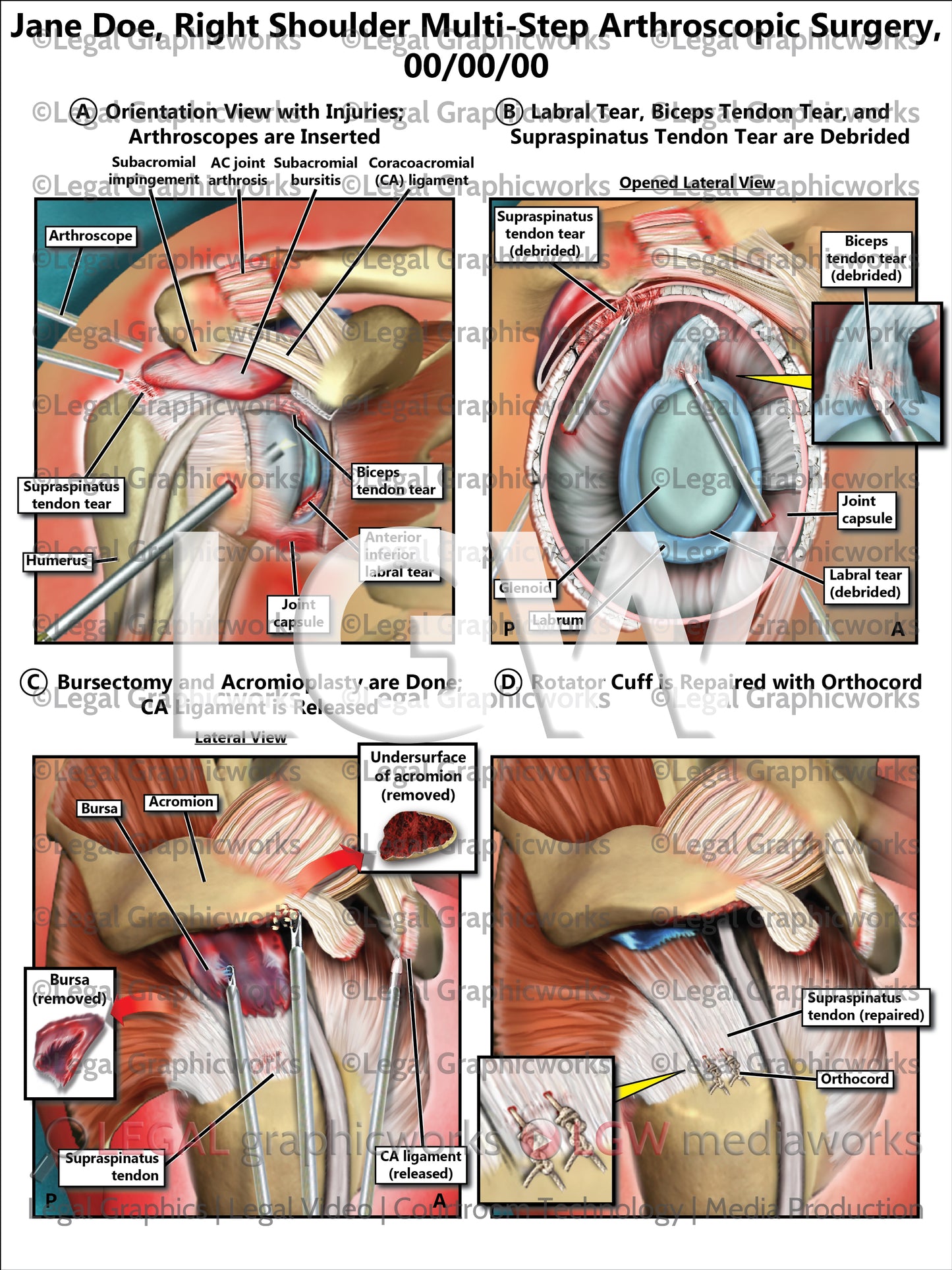 Right Shoulder Multi-Step Arthroscopic Surgery