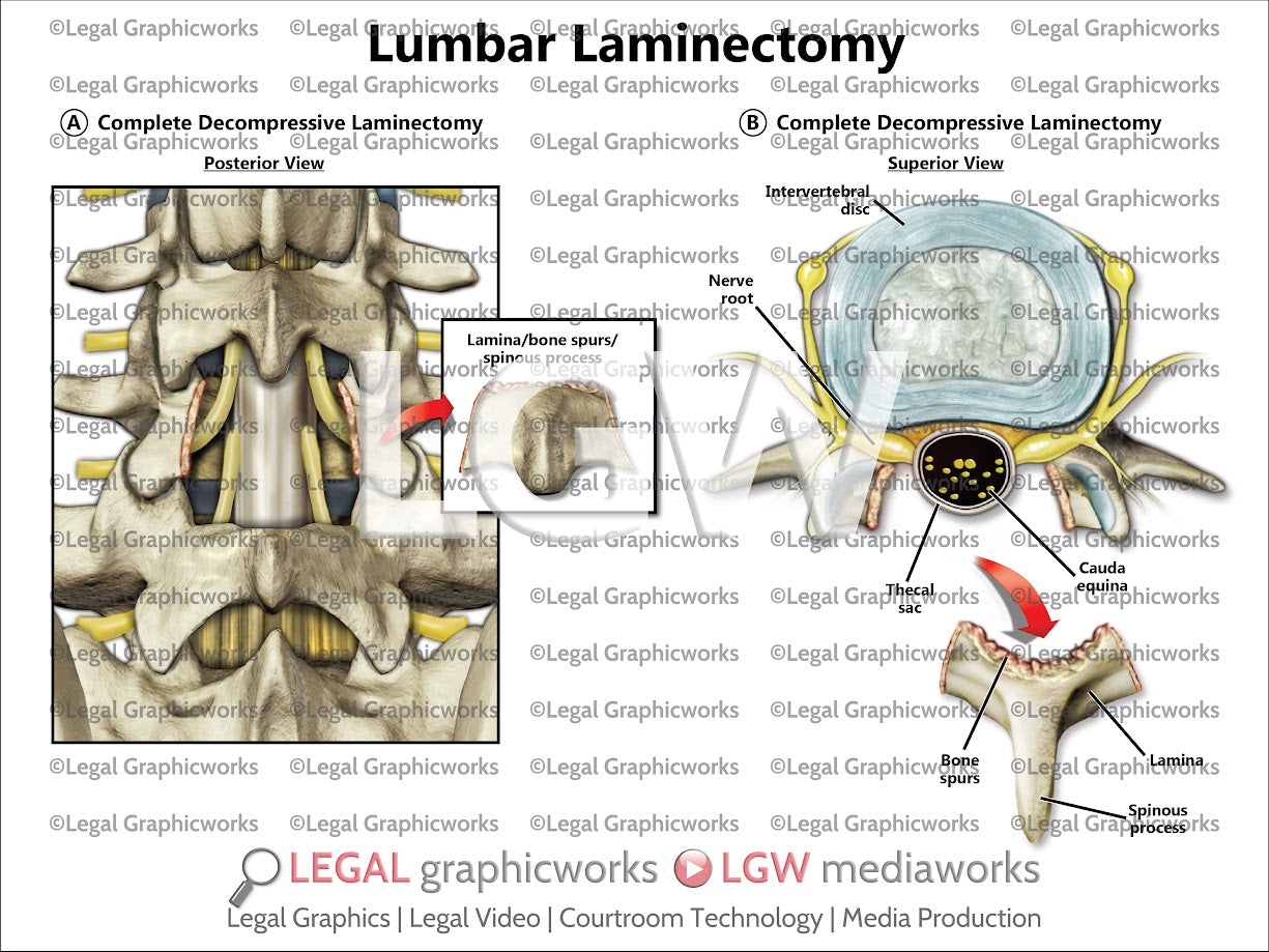 Lumbar Laminectomy