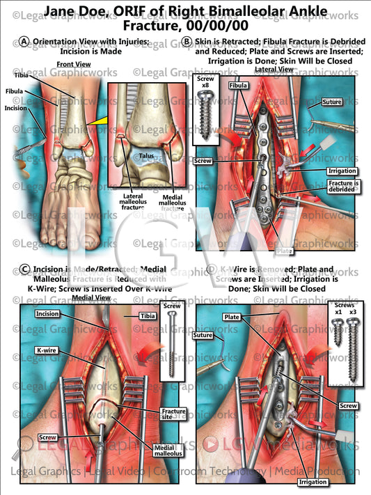 ORIF of Right Bimalleolar Ankle Fracture
