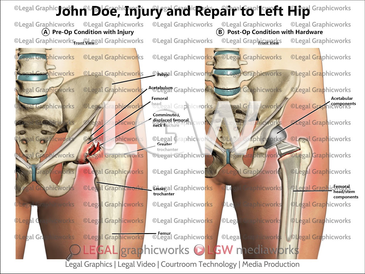 Injury and Repair to Left Hip