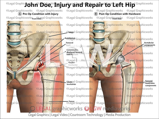 Injury and Repair to Left Hip