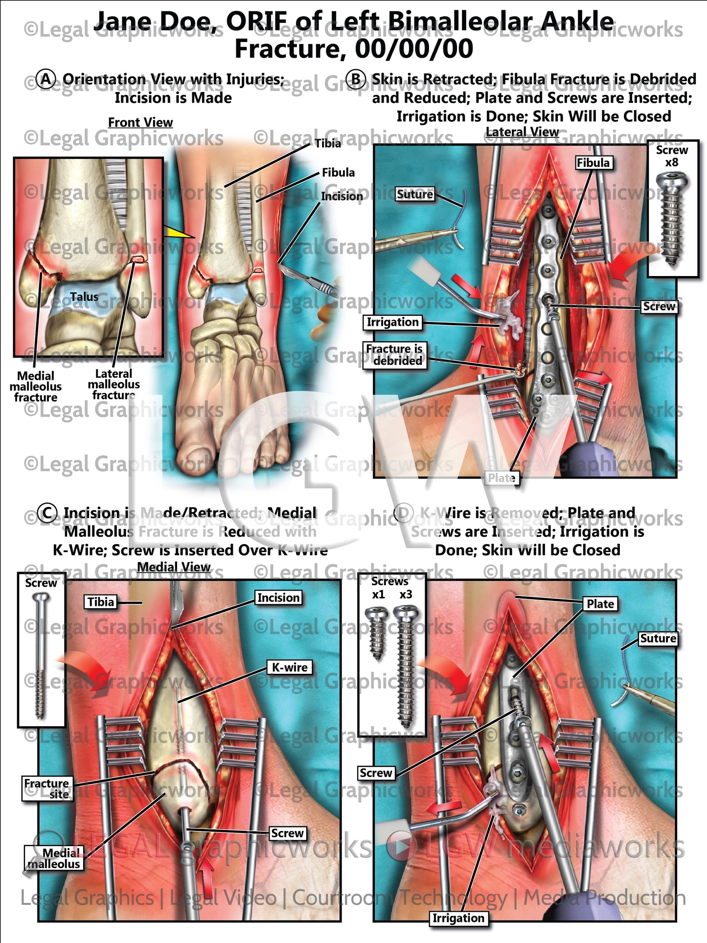 ORIF of Left Bimalleolar Ankle Fracture