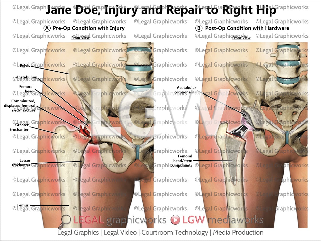 Injury and Repair to Right Hip