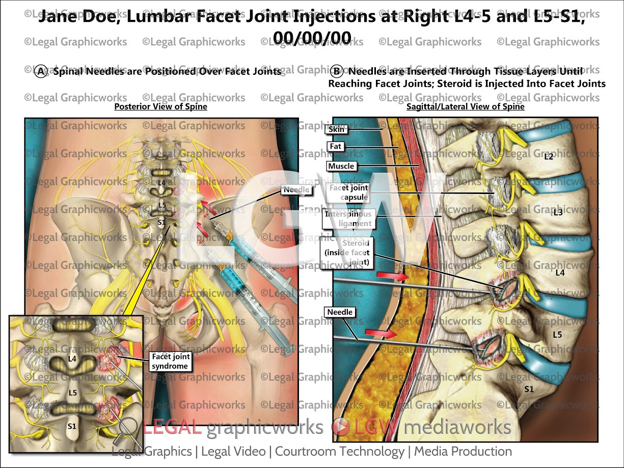 Lumbar Facet Joint Injections at Right L4-5 and L5-S1