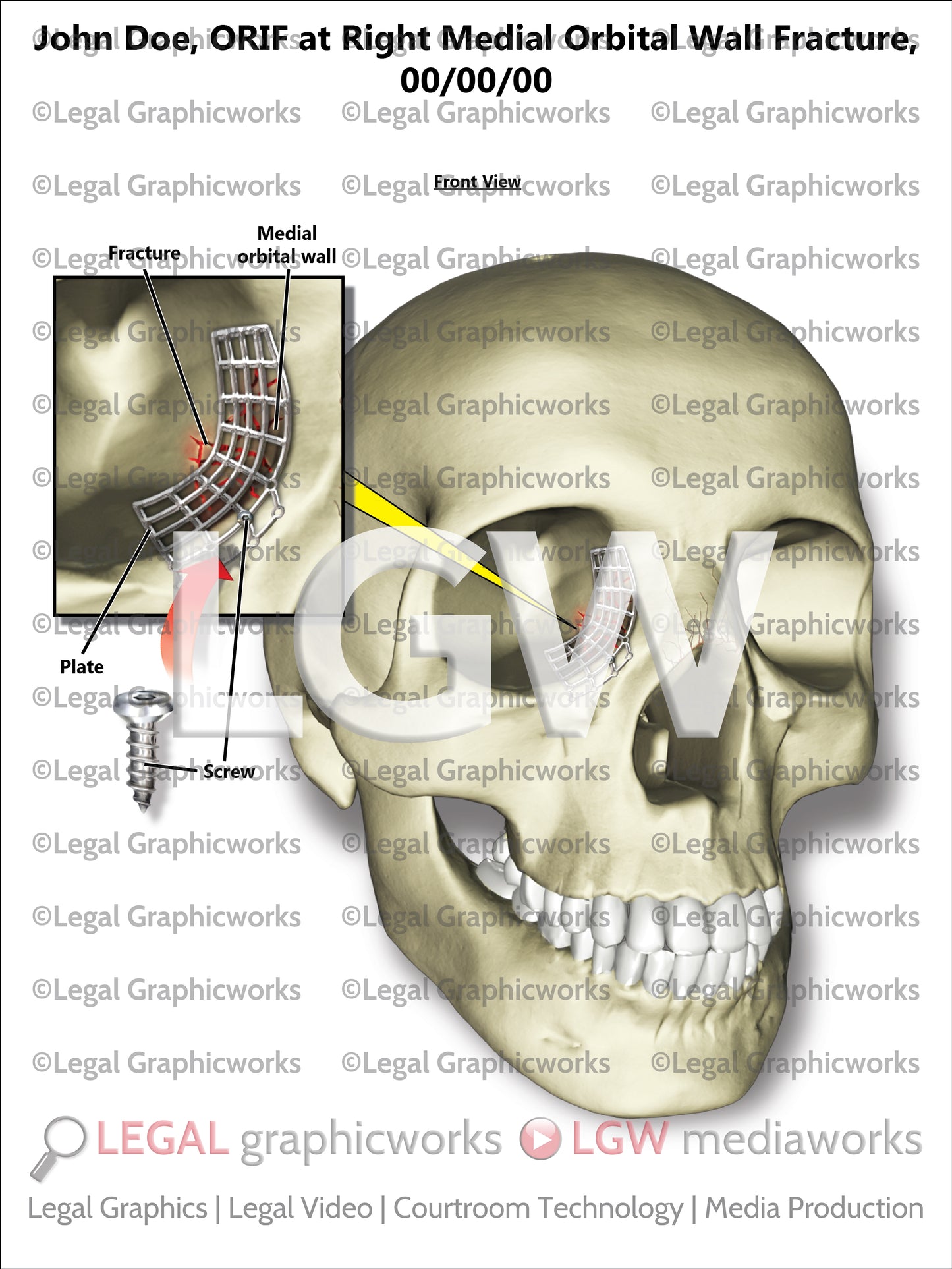 ORIF at Right Medial Orbital Wall Fracture