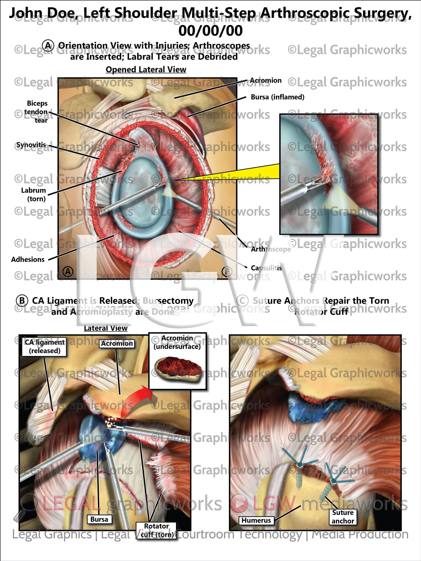 Left Shoulder Multi-Step Arthroscopic Surgery