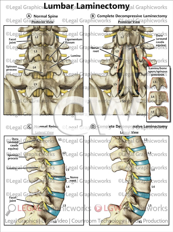 Lumbar Laminectomy