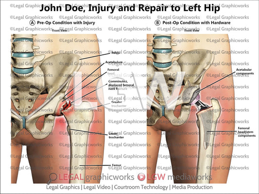 Injury and Repair to Left Hip