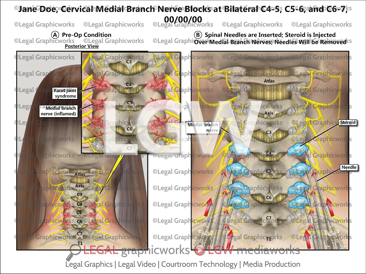 Cervical Medial Branch Nerve Blocks at Bilateral C4-5, C5-6, and C6-7