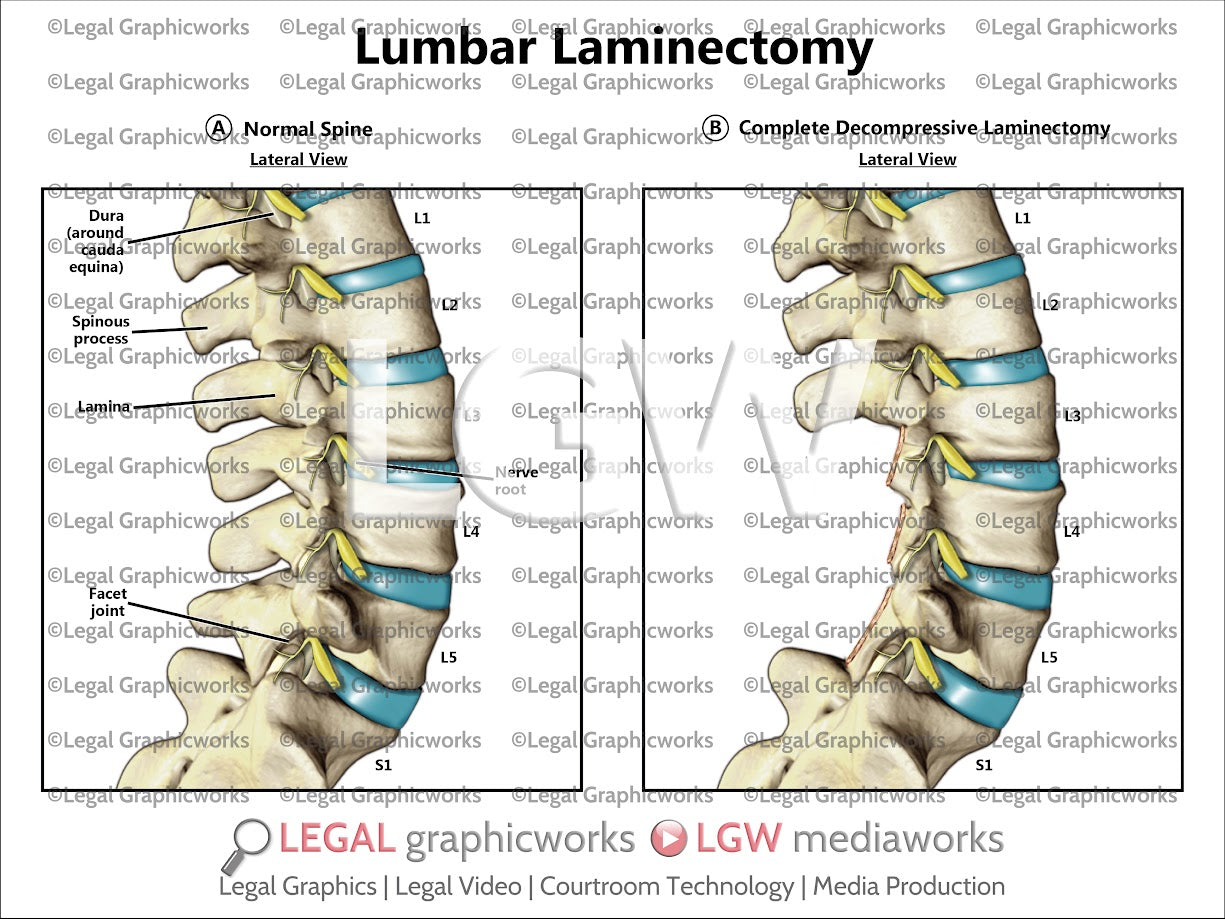 Lumbar Laminectomy