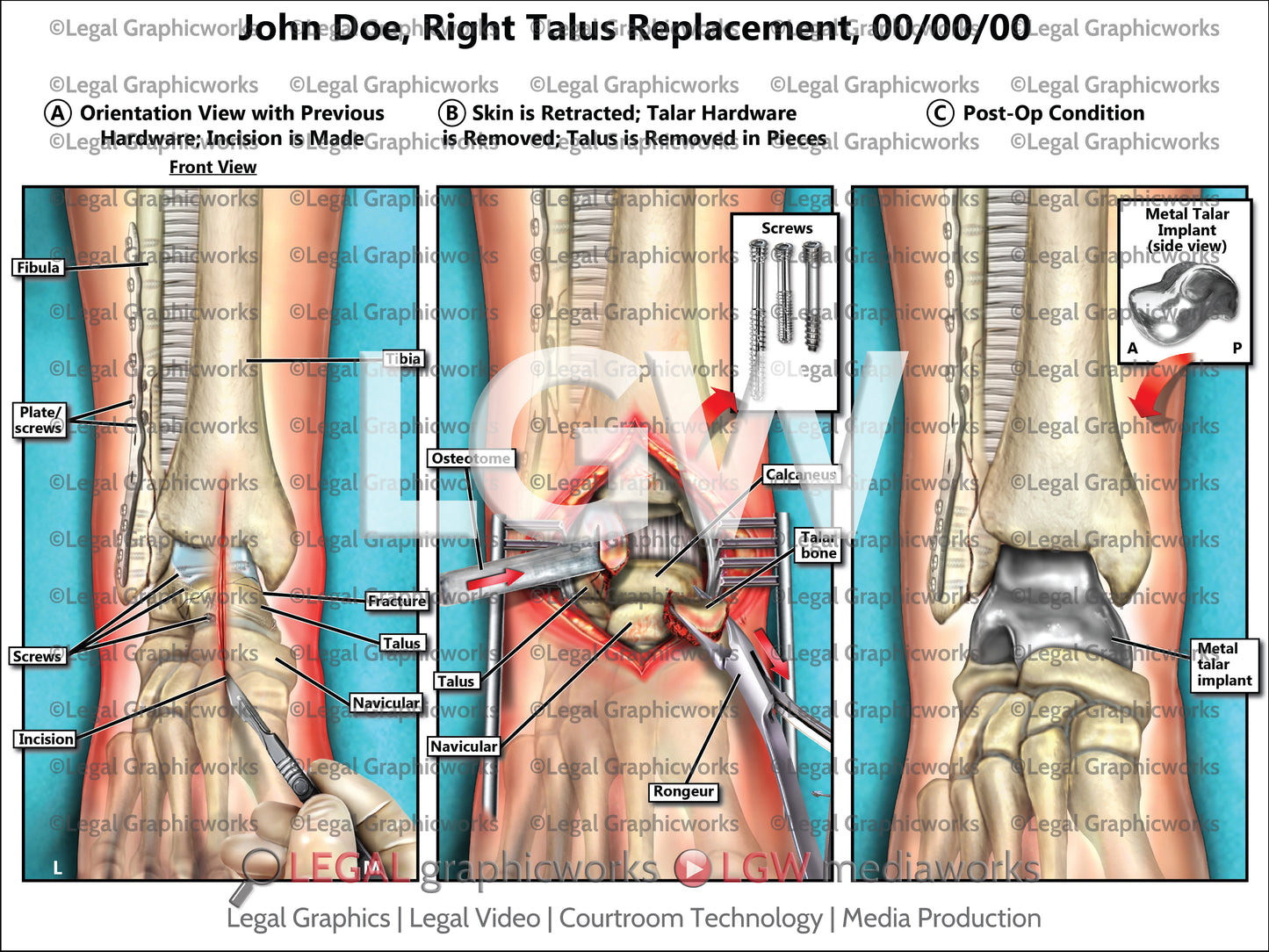 Right Talus Replacement