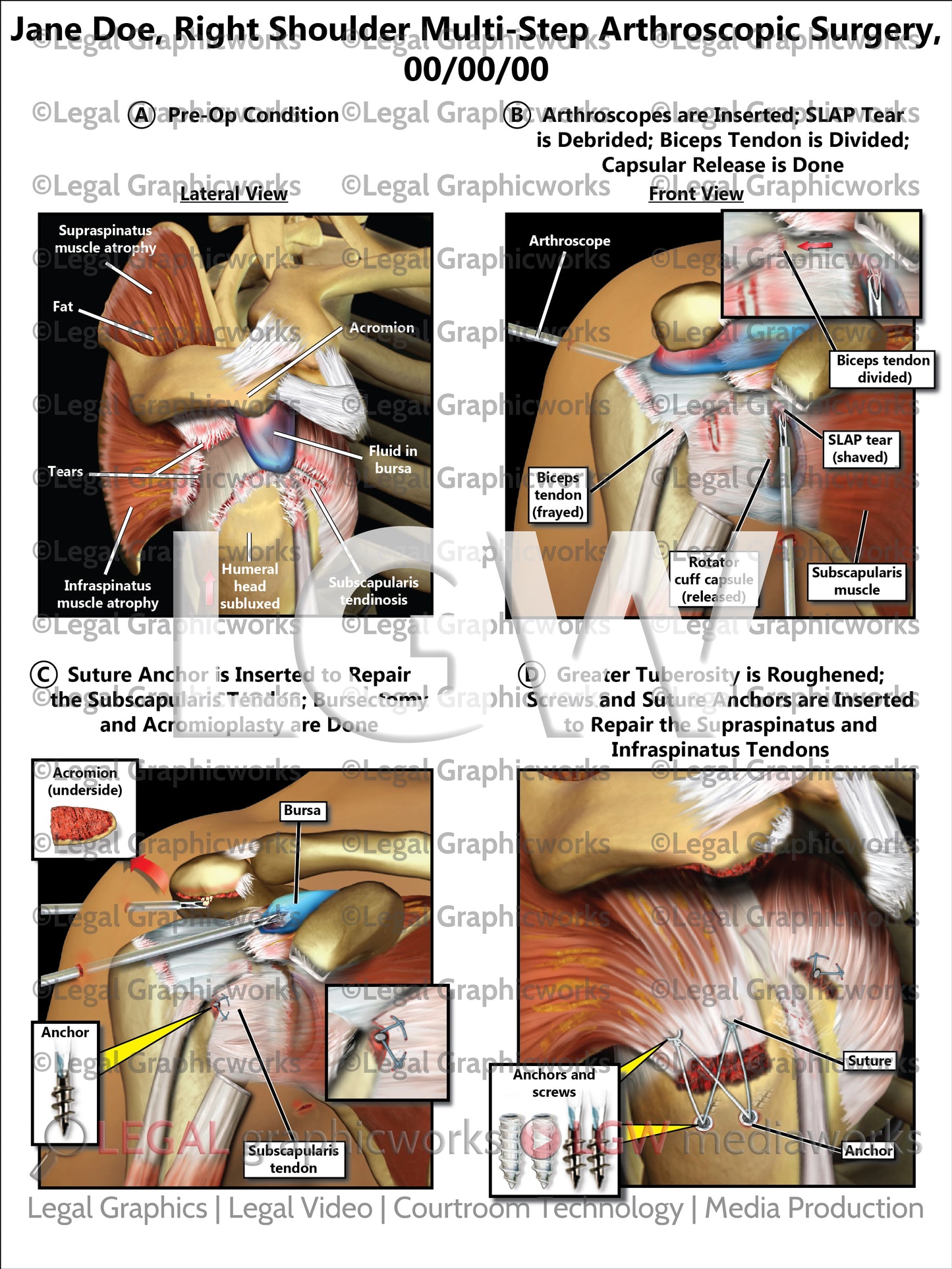 Right Shoulder Multi-Step Arthroscopic Surgery