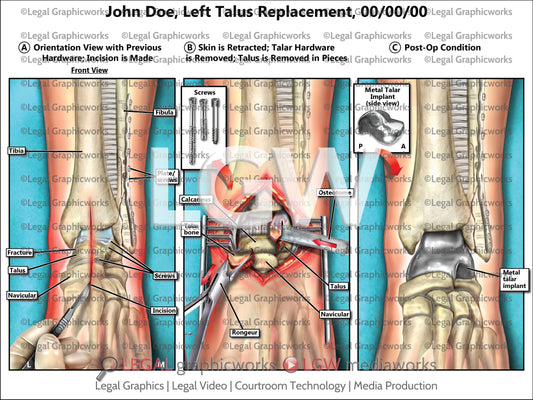 Left Talus Replacement
