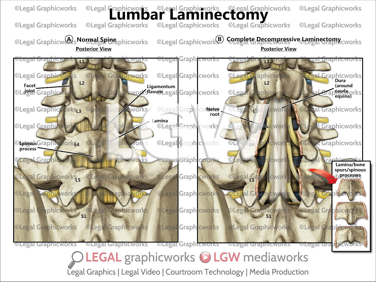 Lumbar Laminectomy