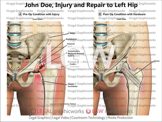 Injury and Repair to Left Hip