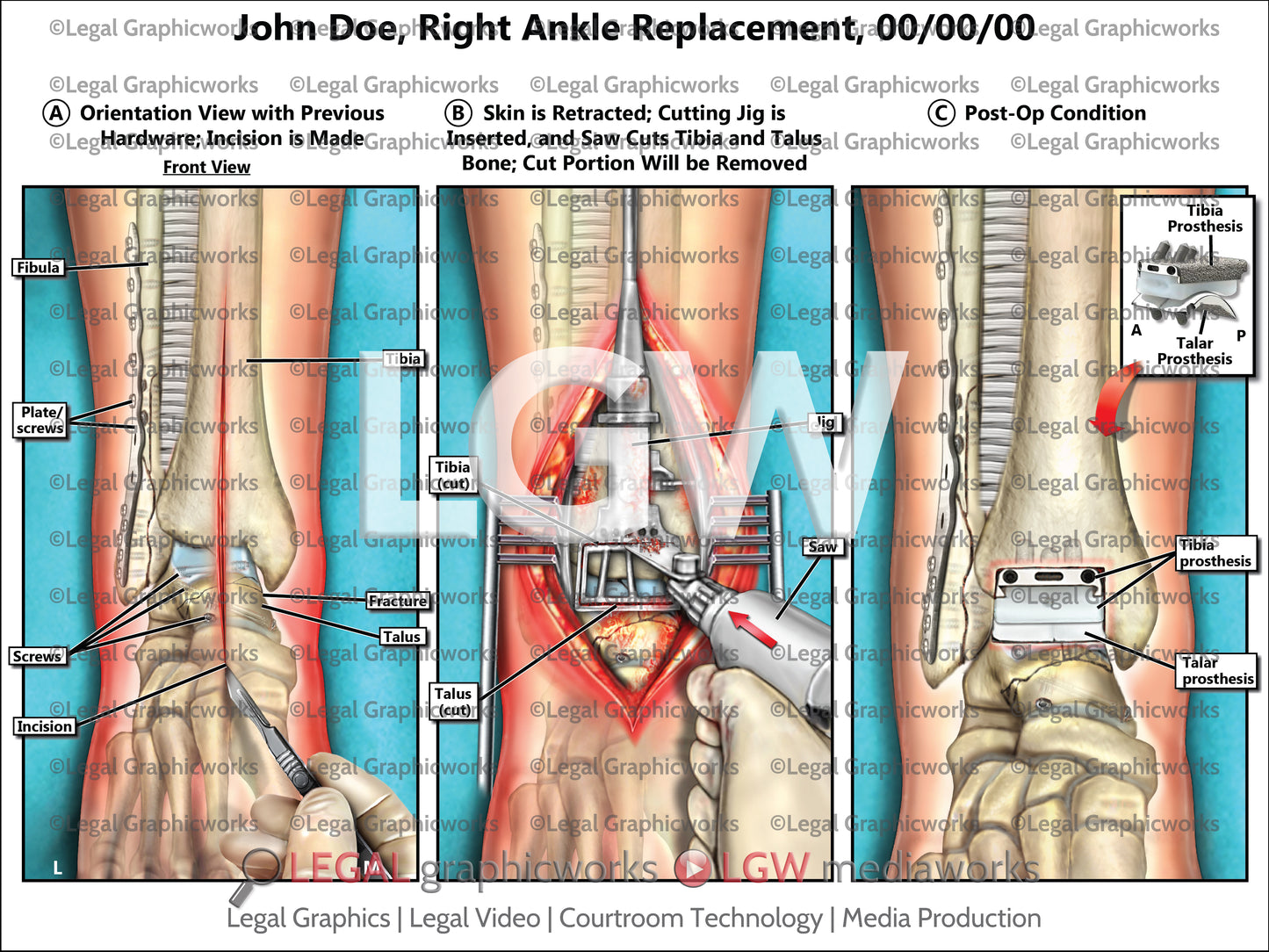 Right Ankle Replacement