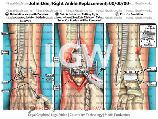 Right Ankle Replacement
