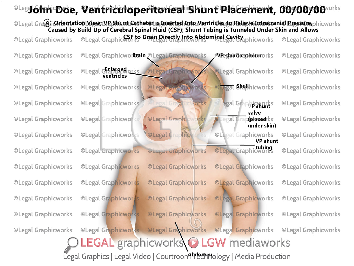 Ventriculoperitoneal Shunt Placement