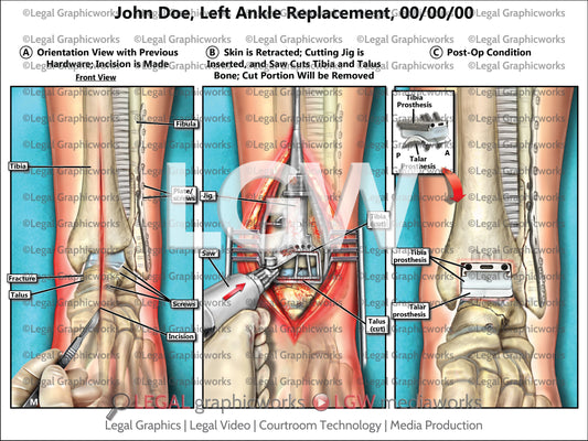 Left Ankle Replacement
