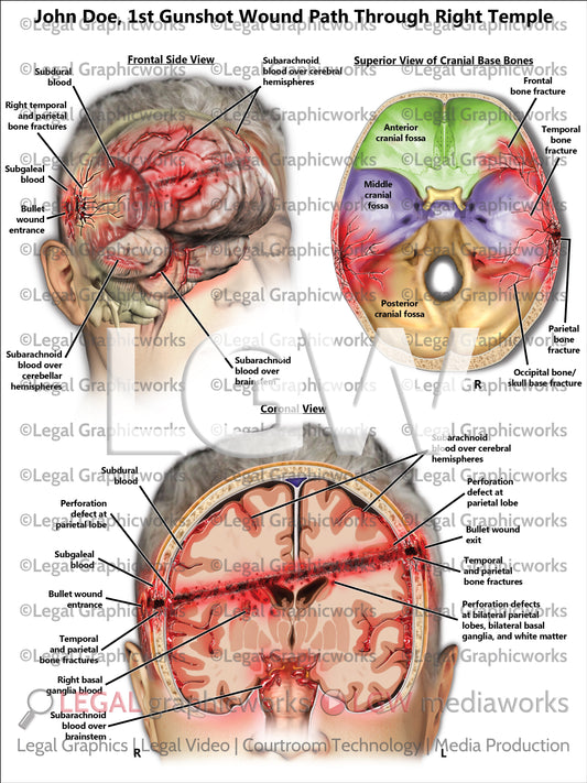 1st Gunshot Wound Path Through Right Temple