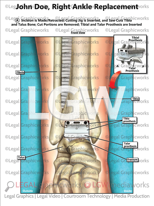 Right Ankle Replacement