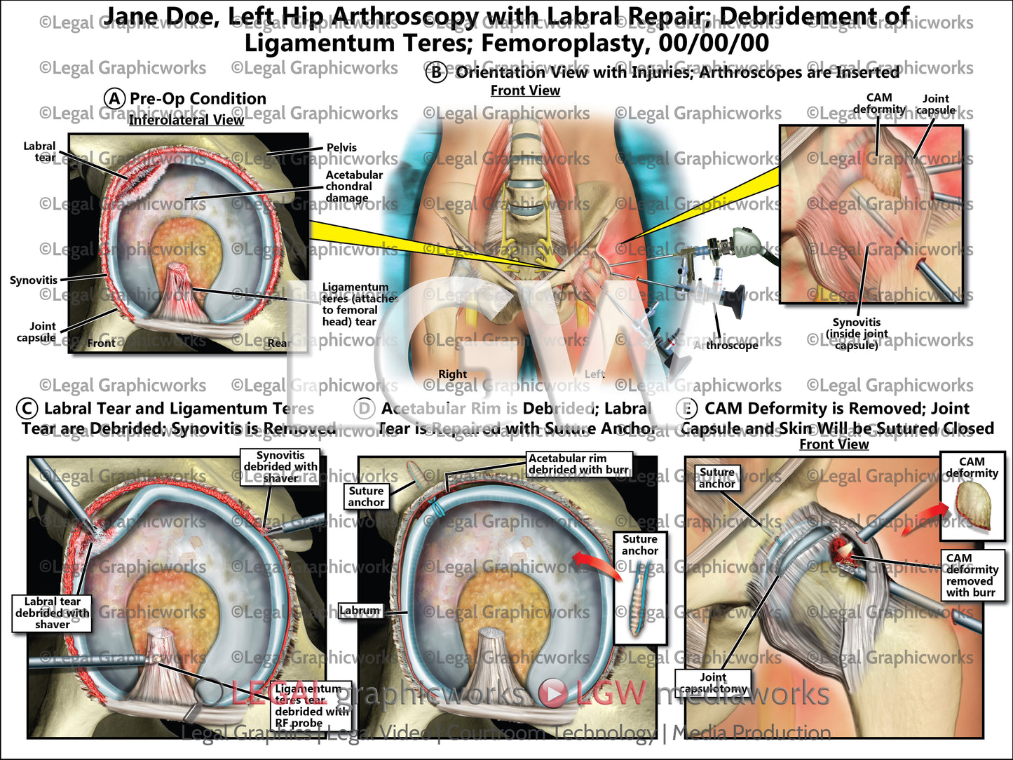 Left Hip Arthroscopy with Labral Repair; Debridement of Ligamentum Teres; Femoroplasty
