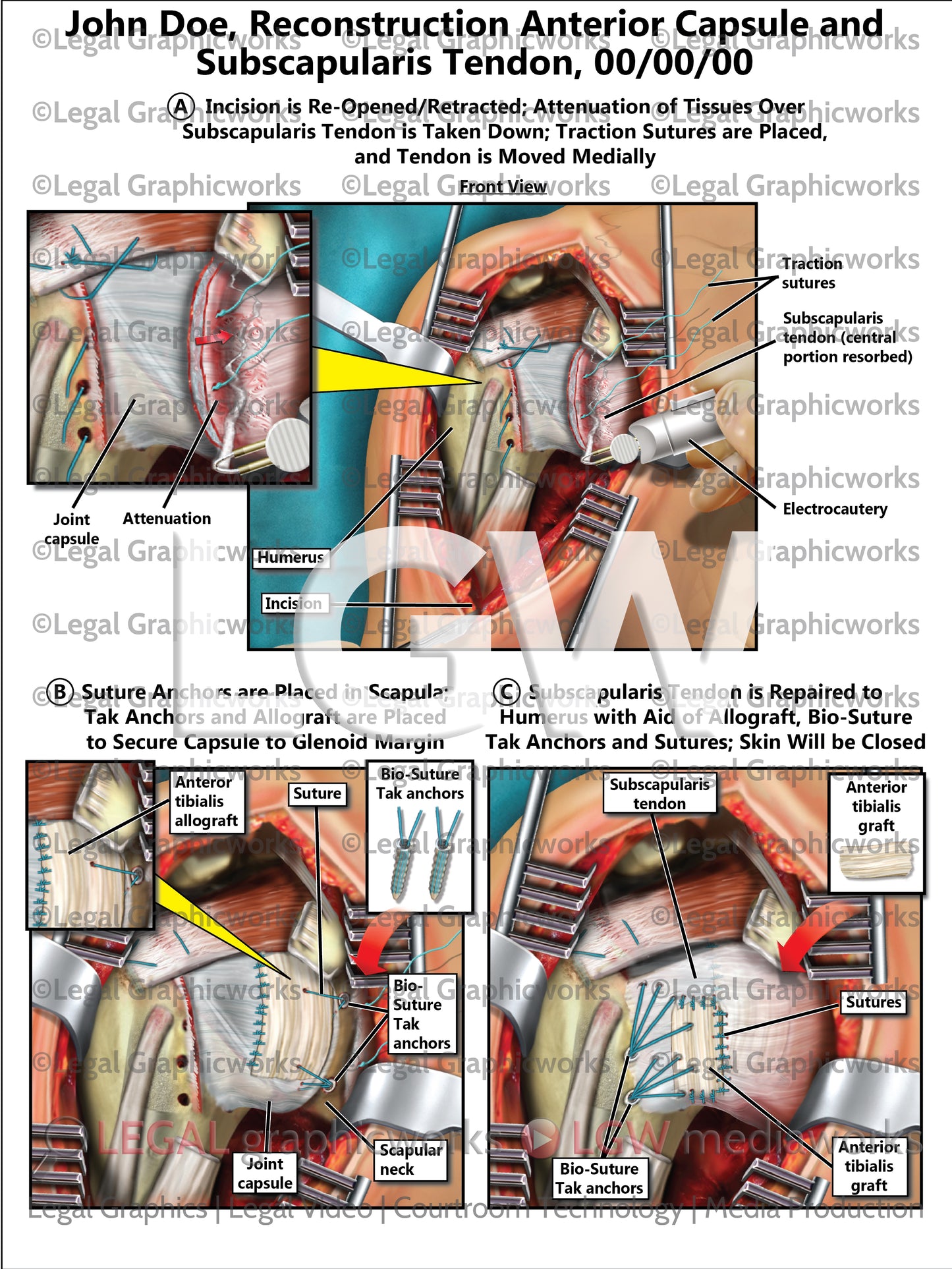 Reconstruction Anterior Capsule and Subscapularis Tendon