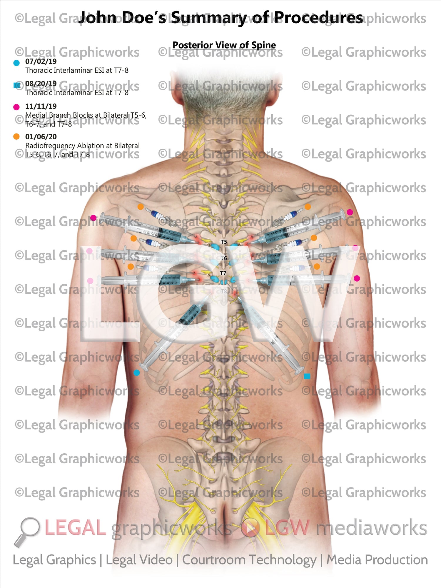 Injections