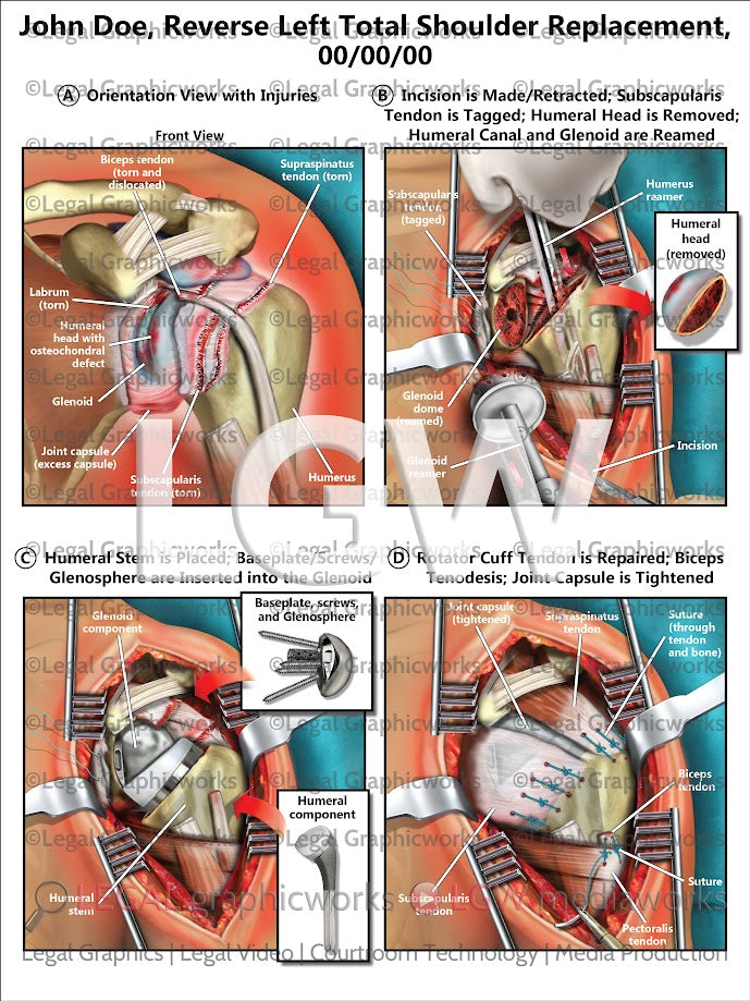 Reverse Left Total Shoulder Replacement