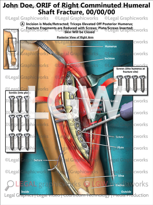 ORIF of Right Comminuted Humeral Shaft Fracture