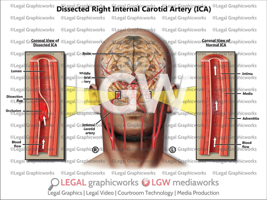 Dissected Right Internal Carotid Artery (ICA)