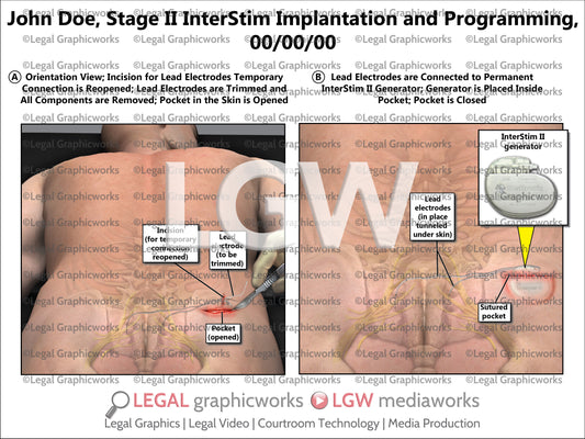 Stage II InterStim Implantation and Programming