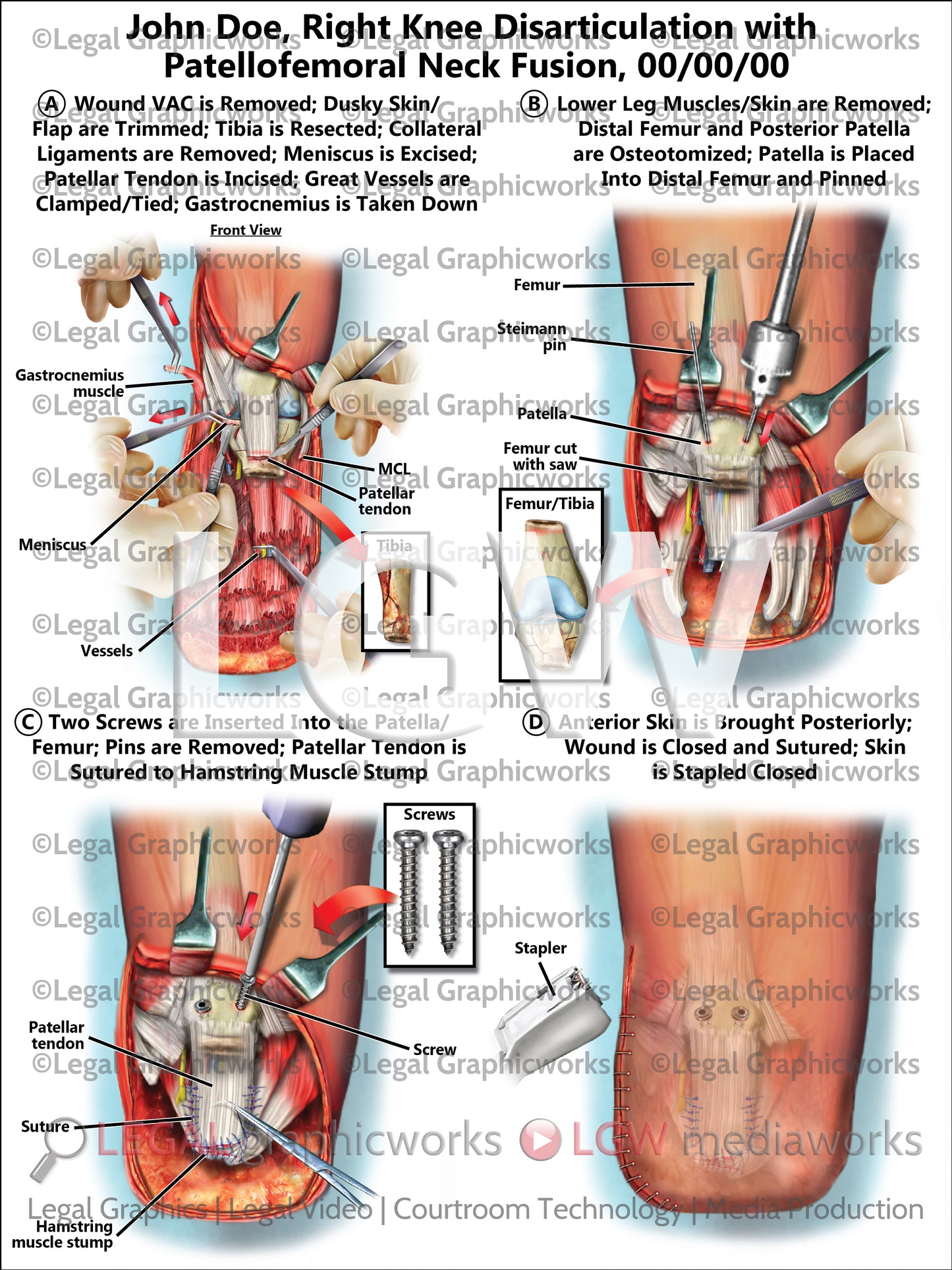Right Knee Disarticulation with Patellofemoral Neck Fusion