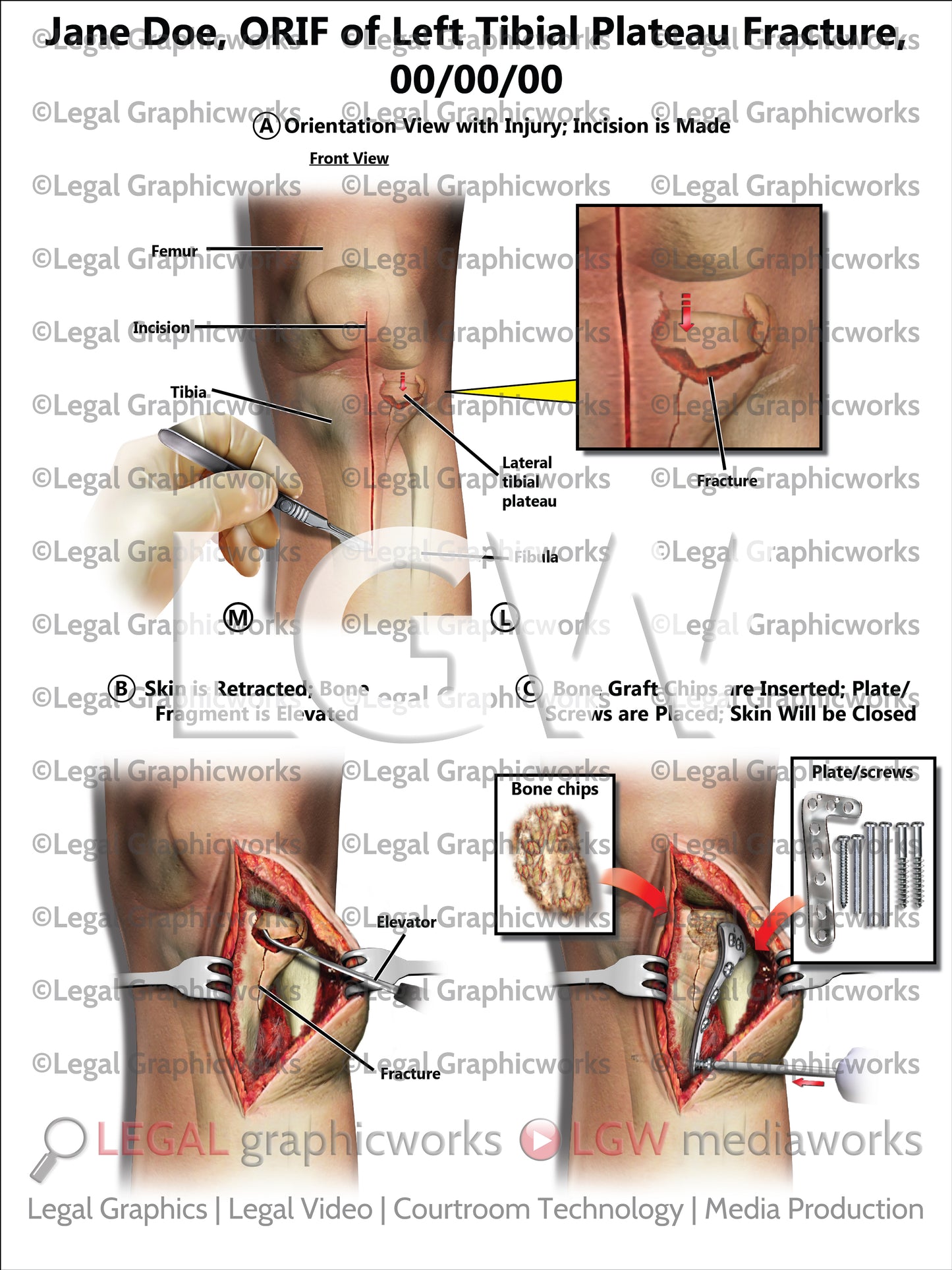 ORIF of Left Tibial Plateau Fracture