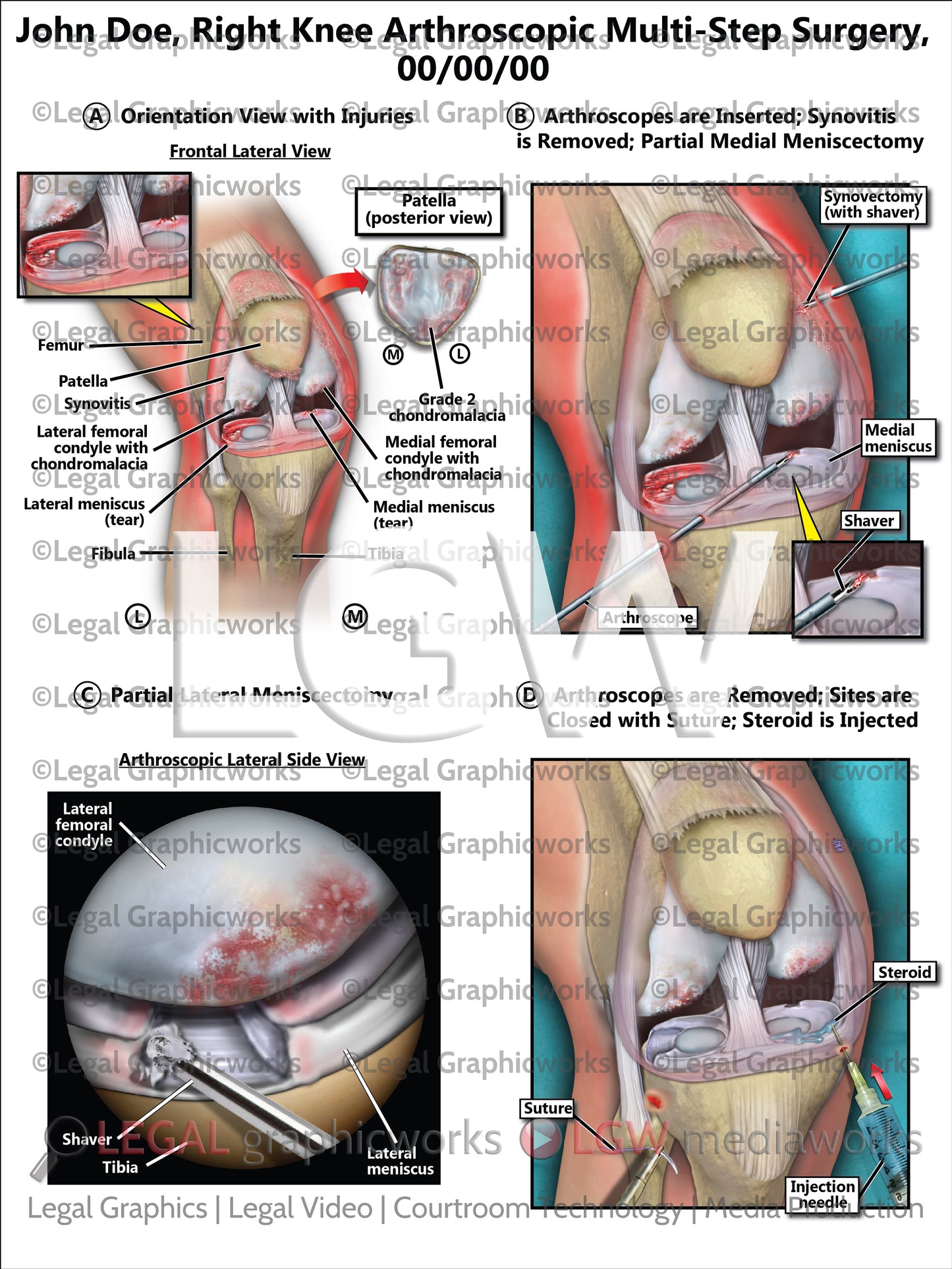 Right Knee Arthroscopic Multi-Step Surgery