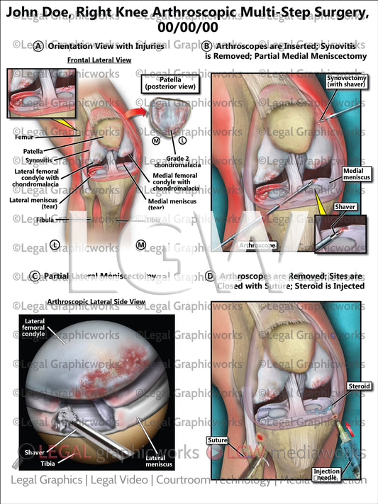 Right Knee Arthroscopic Multi-Step Surgery