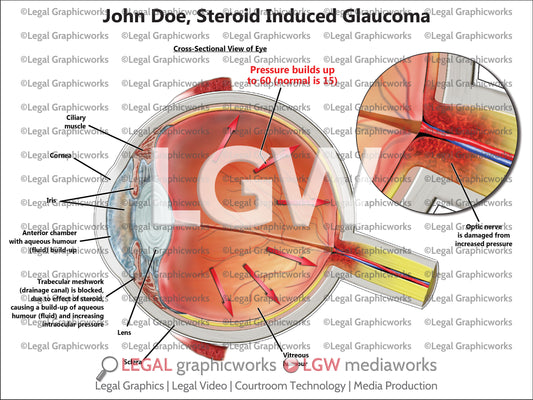 Steroid Induced Glaucoma