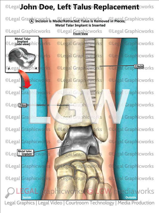 Left Talus Replacement