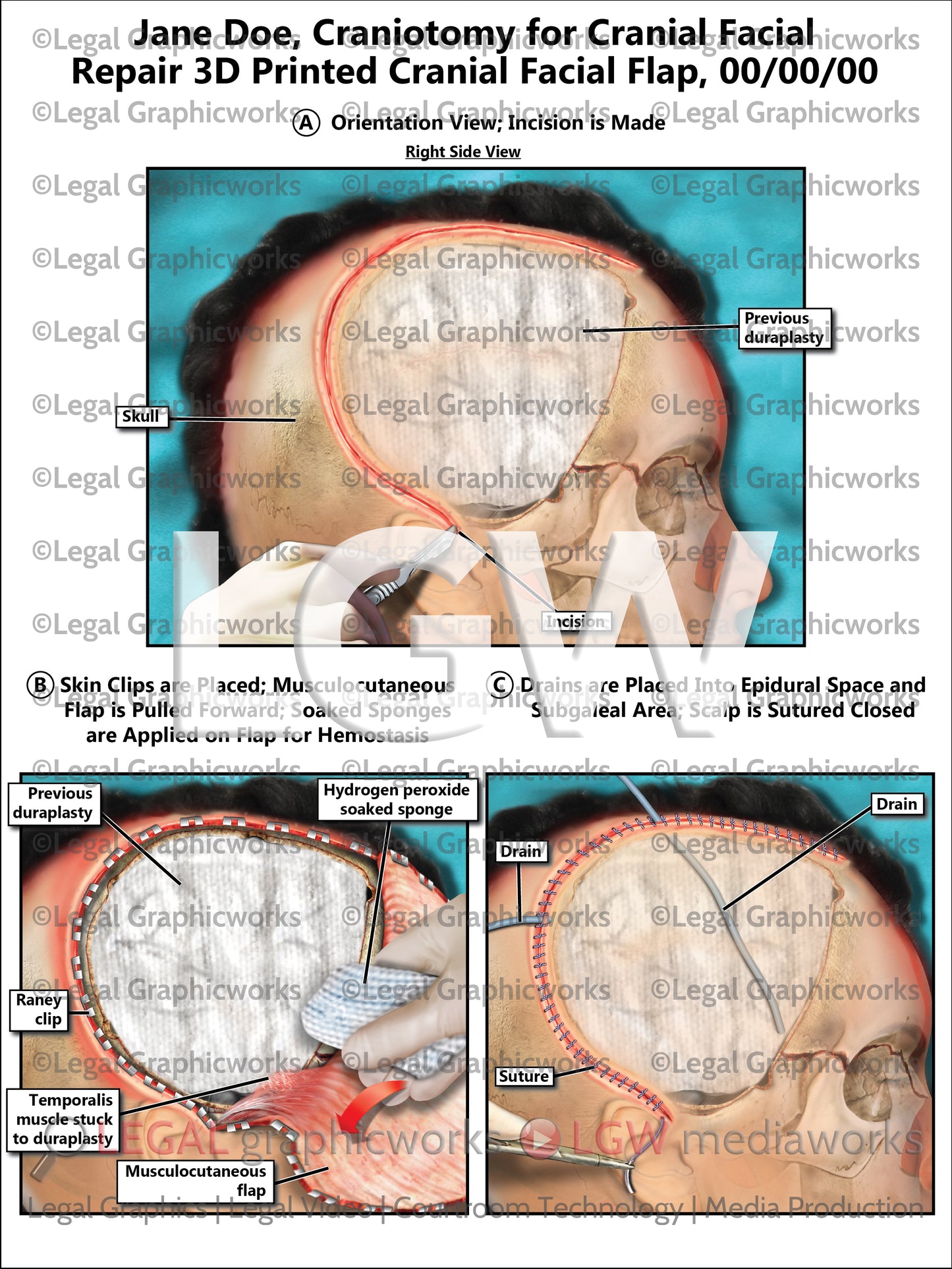 Craniotomy for Cranial Facial Repair 3D Printed Cranial Facial Flap